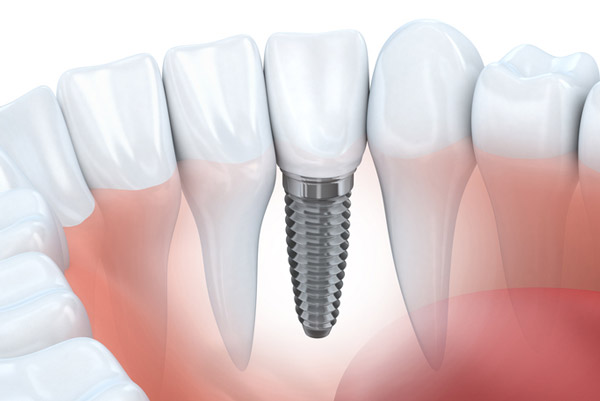 Diagram of dental implant in lower jaw from Palani Center for Dental Implants, in Rancho Palos Verdes CA